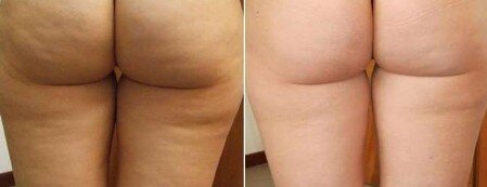 Cellulite trattamento corpo